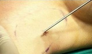 狐臭的成因与治疗方法详解