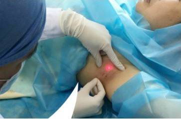 涨知识|腋毛太多真的会导致腋臭吗?科学解读腋臭与狐臭的真相