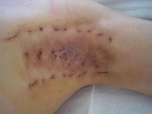 治狐臭的常见误区 为何越掩盖越严重?